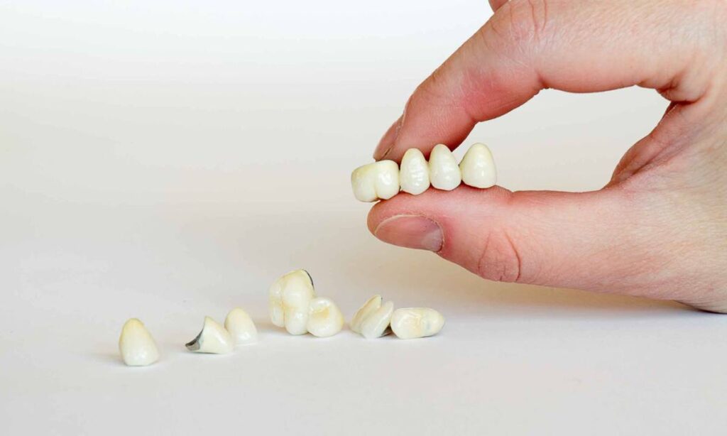 Dental Bridge