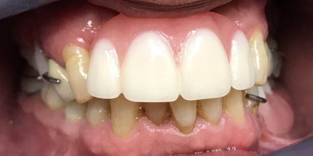 After Dental Denture