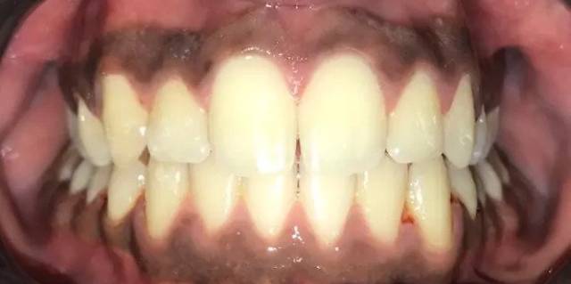After Treatment Slide 1