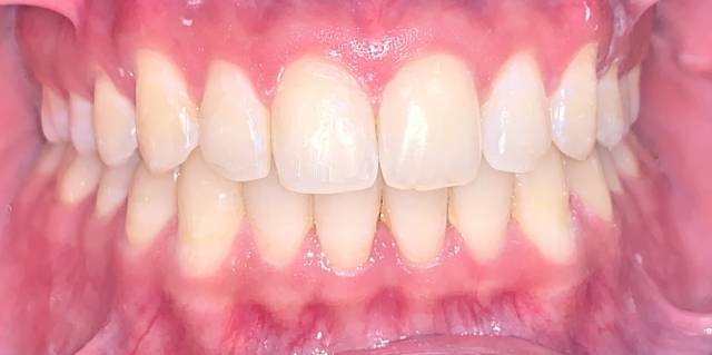 After Treatment Slide 2