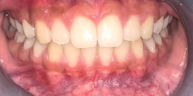 After Treatment Slide 4