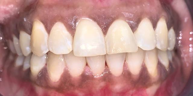 After Treatment Slide 3