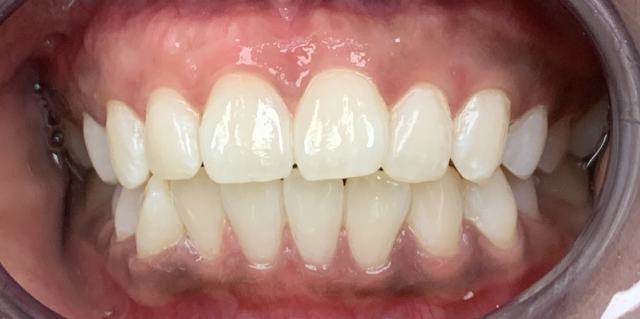patient 2 results, Coit Dental Frisco