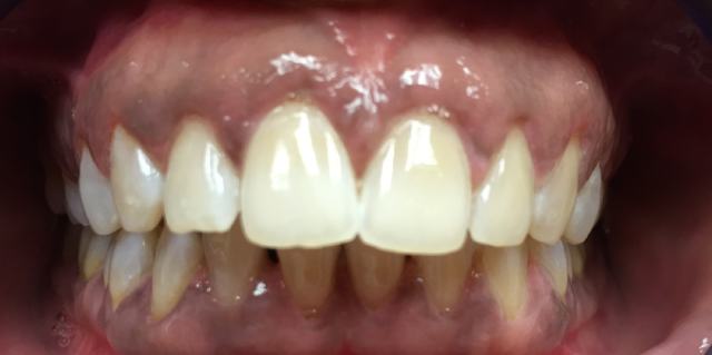 dramatically whiter smile, Coit Dental