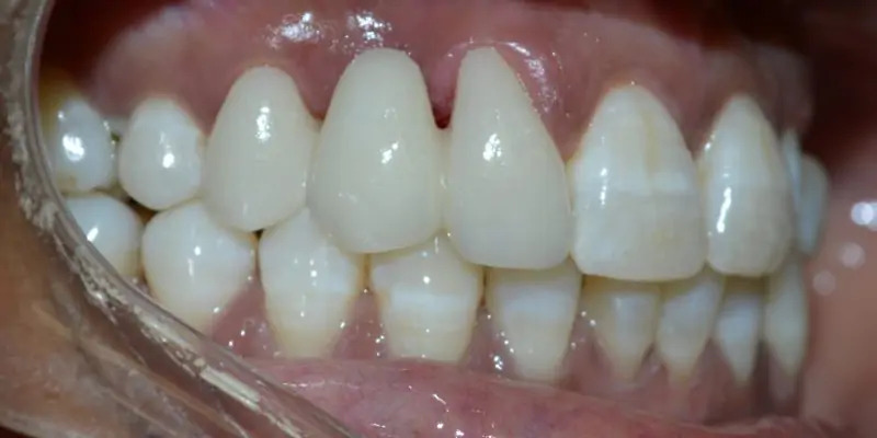 After porcelain veneers – bright natural smile patient 3, Coit Dental Frisco TX