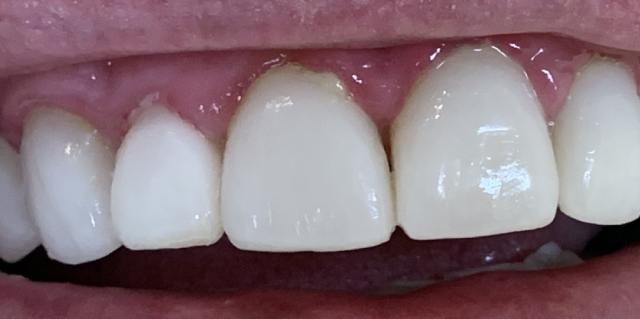 After dental veneers – patient 2 smile makeover result, Coit Dental Frisco TX