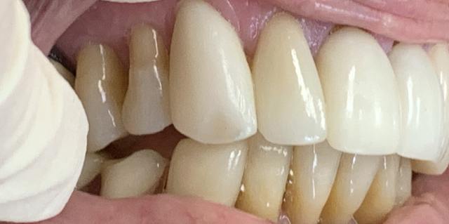 Porcelain veneers after treatment – patient 1 smile transformation, Coit Dental Frisco TX