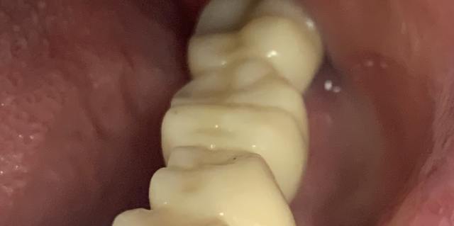 After dental bridge result – natural looking tooth replacement patient 2, Coit Dental Frisco TX