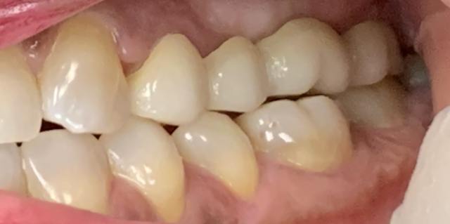 Dental bridge after result – seamless smile patient 3, Coit Dental Frisco TX