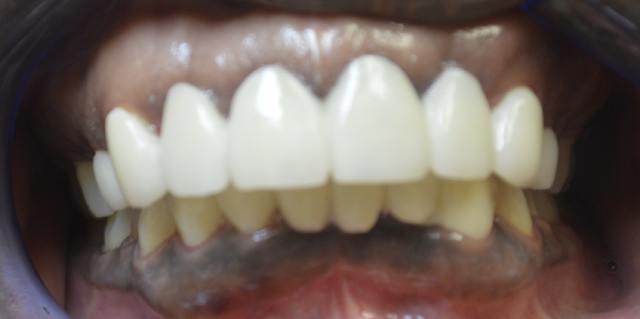 After porcelain dental bridge treatment – patient 4 restored smile, Coit Dental Frisco TX