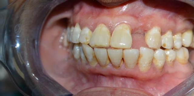Before Dental Denture