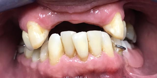 Before Dental Denture