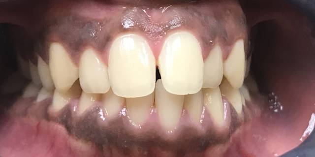 Before Treatment Slide 1