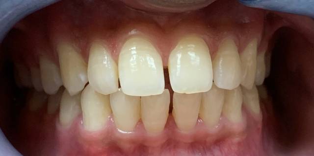Before Treatment Slide 2