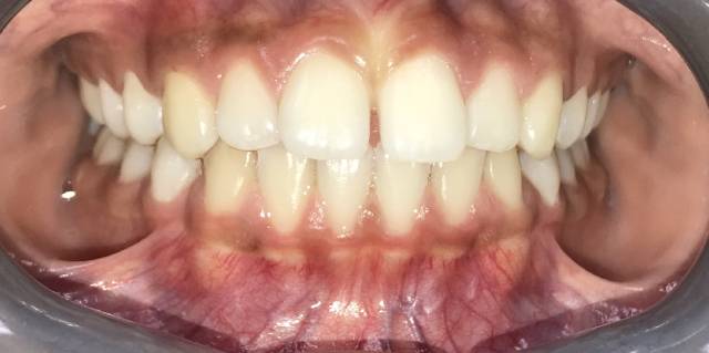 Before Treatment Slide 3