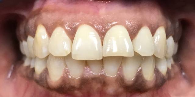 Before Treatment Slide 4