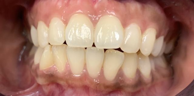 patient 2 at Coit Dental Frisco TX