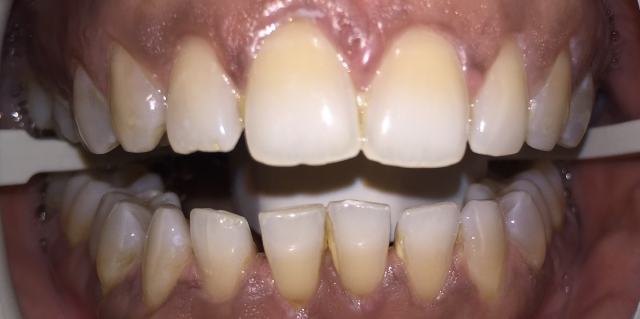 patient 1 at Coit Dental Frisco TX