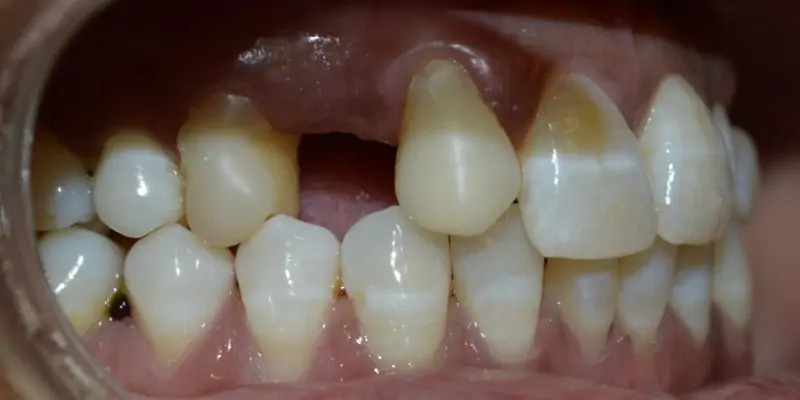 Before veneers – discolored teeth patient 3, Coit Dental Frisco TX