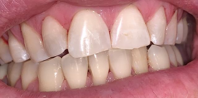 Before dental veneers procedure – patient 2 smile, Coit Dental Frisco TX
