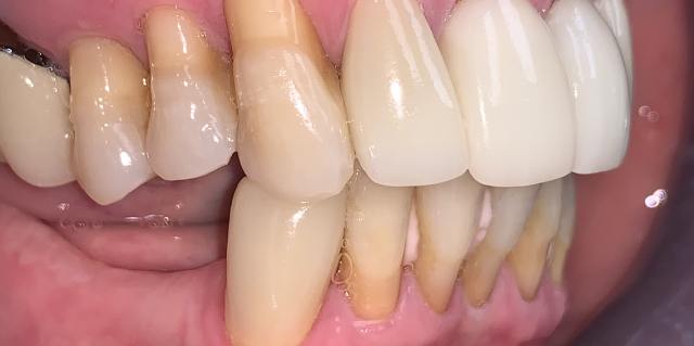 Dental veneers before treatment – patient 1 teeth condition, Coit Dental Frisco TX