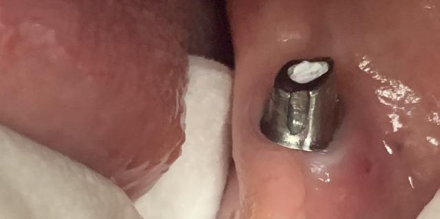 Before dental bridge procedure – missing tooth patient 2, Coit Dental Frisco TX