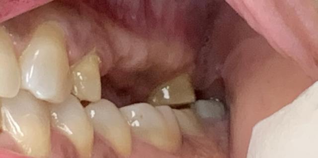 Dental bridge before photo – patient 3 tooth gap, Coit Dental Frisco TX
