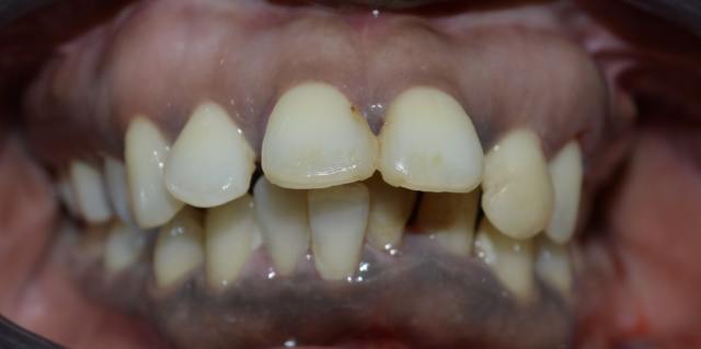 Before porcelain dental bridge – patient 4 missing tooth, Coit Dental Frisco TX