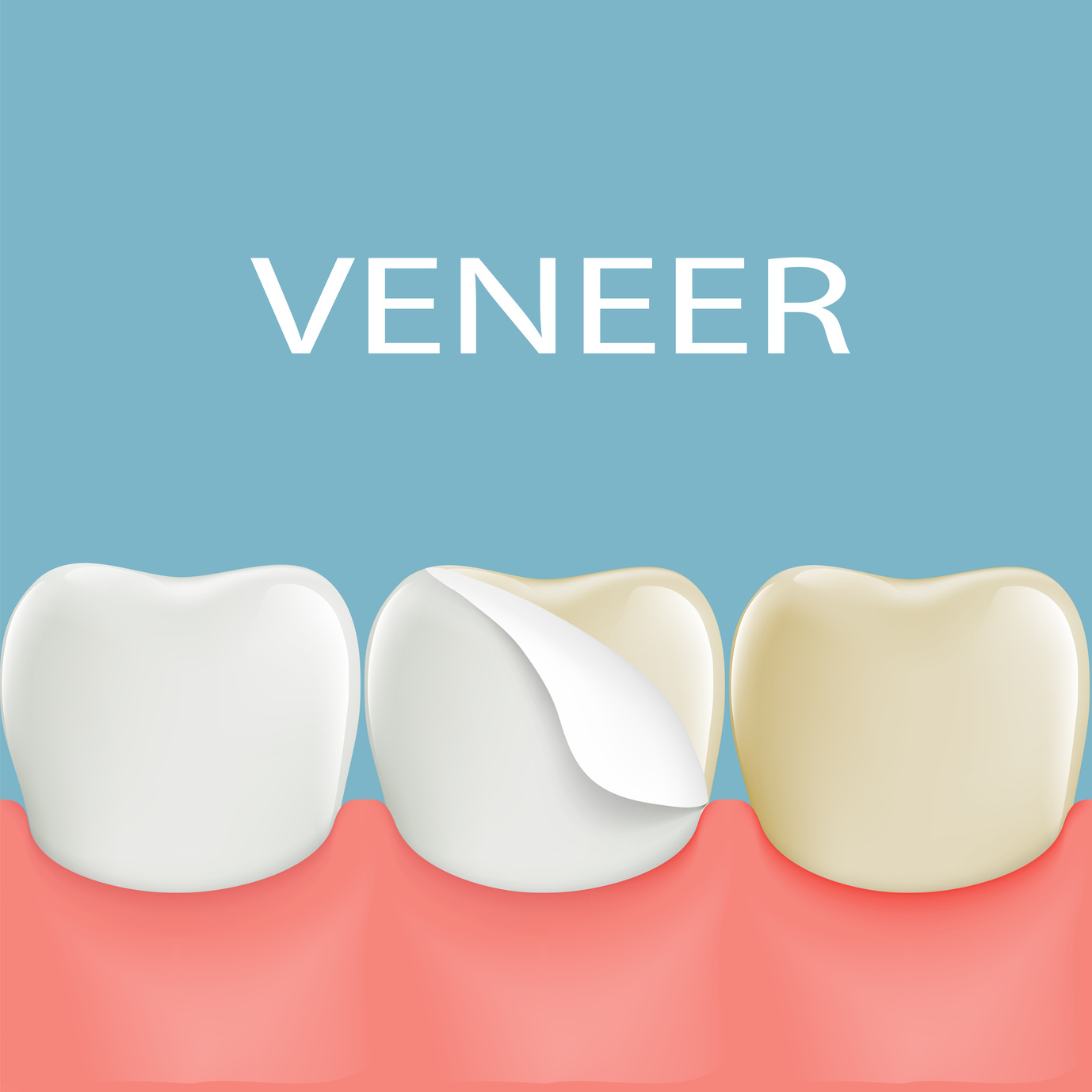Cosmetic Porcelain Veneer