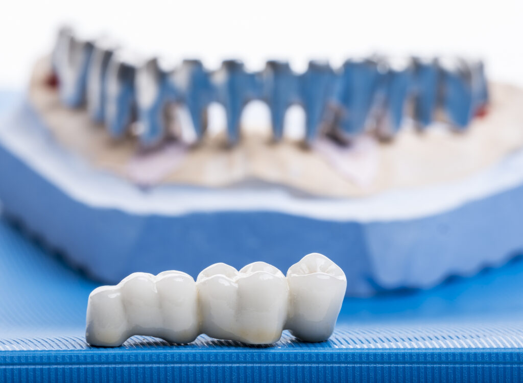 Before dental crown treatment showing damaged tooth