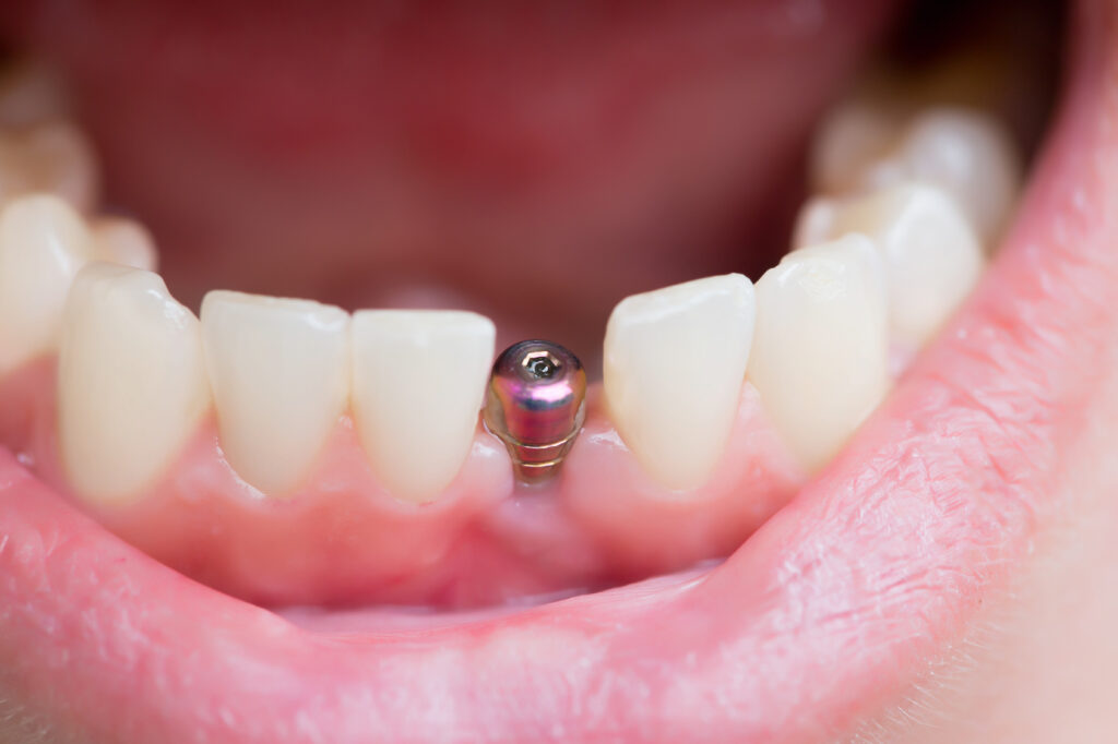 Dental Implant Procedure