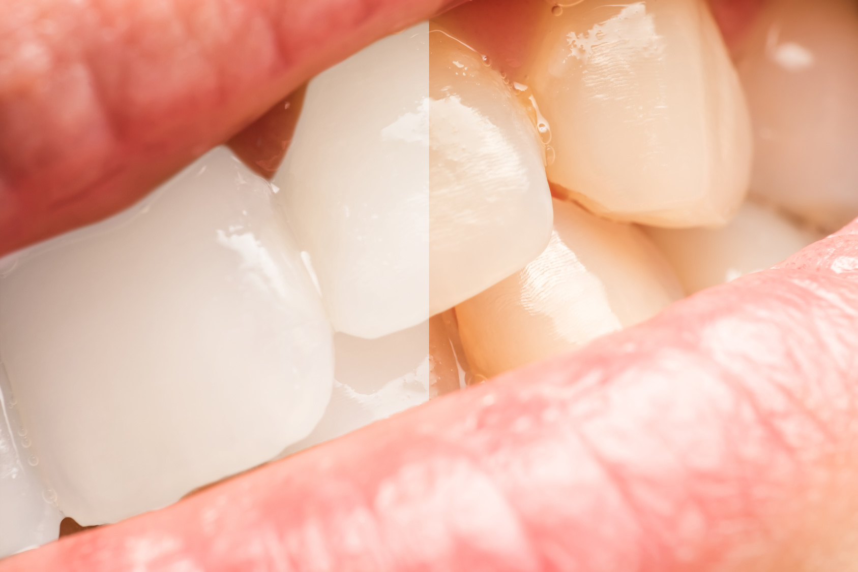Getting Teeth Whitened