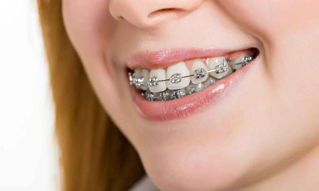 Teen patient with orthodontic braces at Coit Dental in Frisco TX