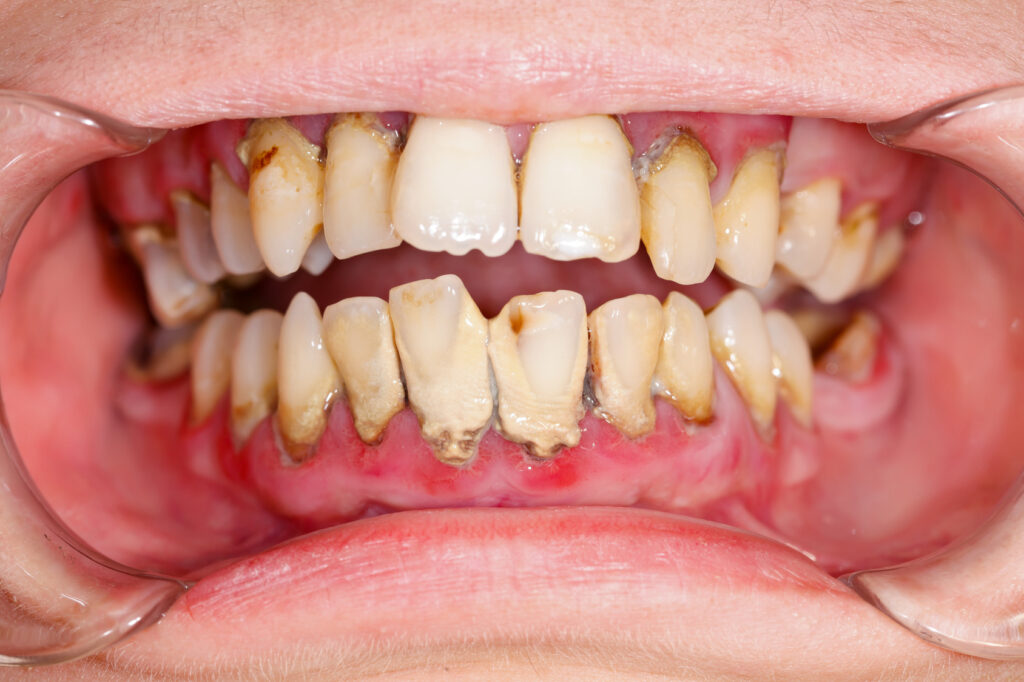 Red, swollen gums and tartar buildup, signs of gum disease
