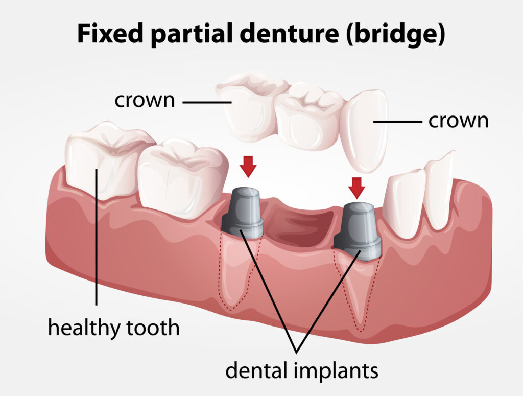 Fixed Partial Dentures